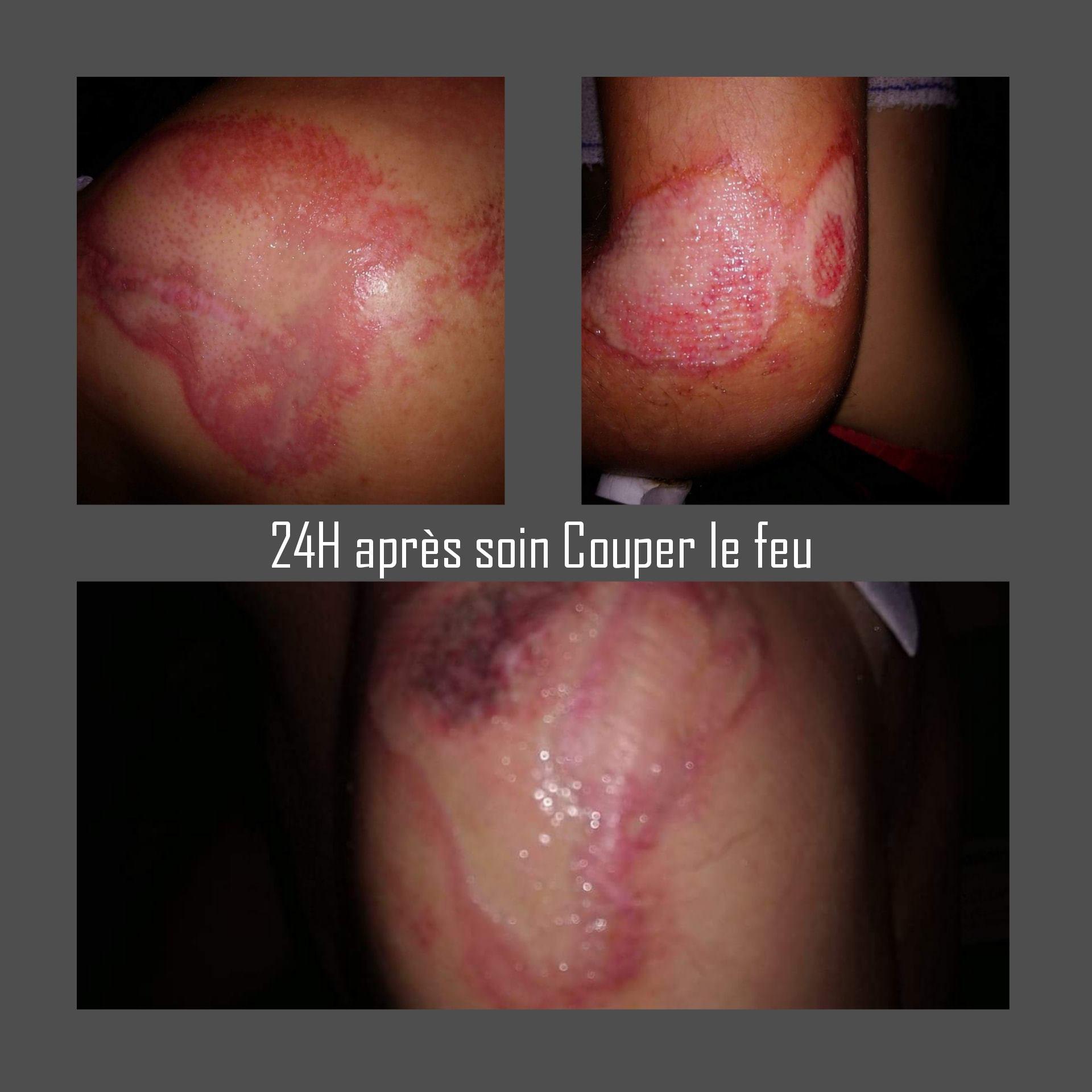 Plaie cicatrisation plus rapide sabrina hedde accompagnatrice mieux etre medium inflamation 2